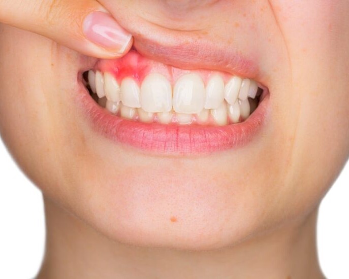 gingivitis síntomas y causas