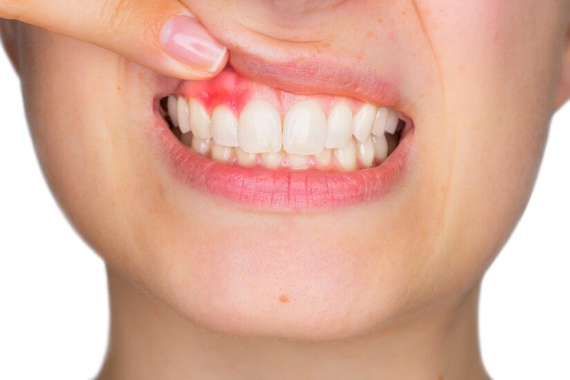 gingivitis síntomas y causas
