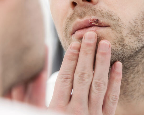 herpes labial