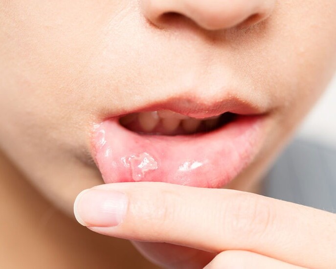 mucocele
