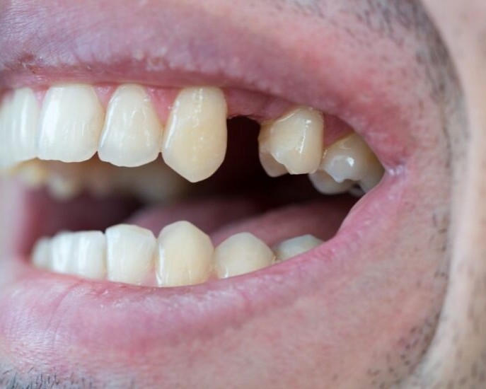 avulsión dental