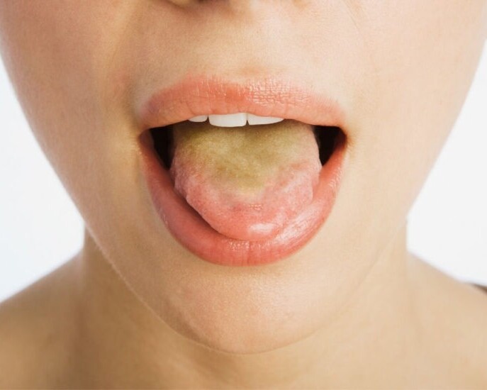 lengua amarilla