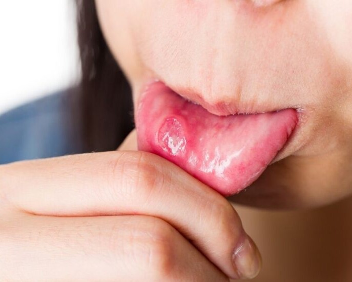 mucositis causas