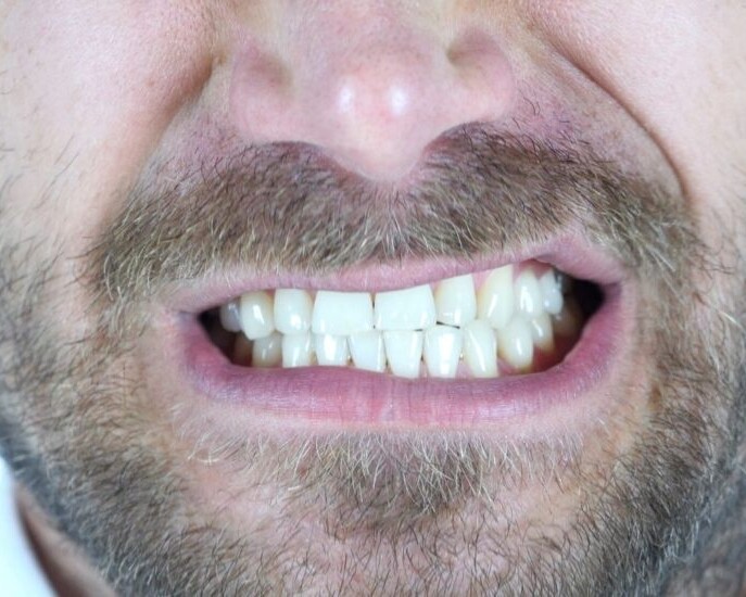bruxismo desgaste dental