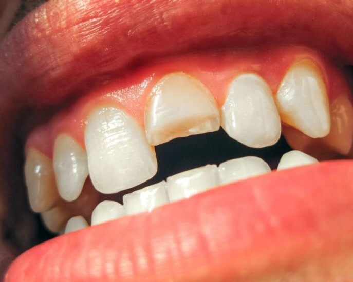 luxación dental
